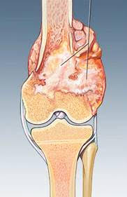 Osteosarcoma femore